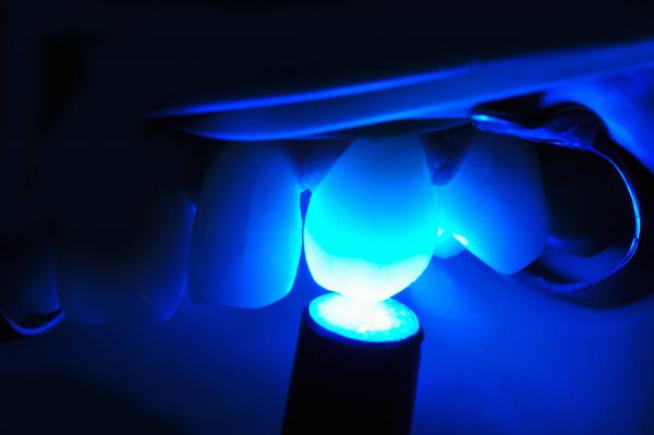 Lichthärtung bei einer zahnärztliche Behandlung